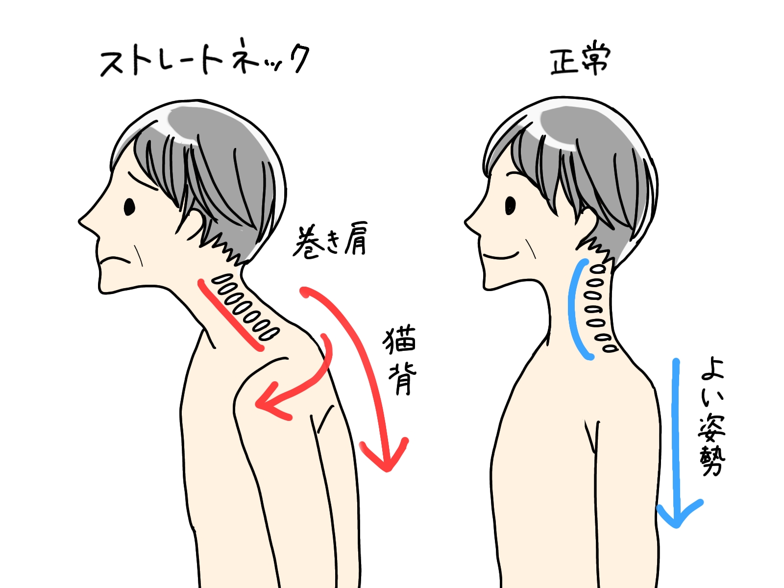 姿勢矯正の必要性